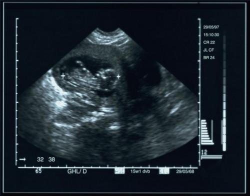 Hvordan gjenkjenne Fetal vekstretardasjon